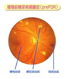 中期 - 前増殖網膜症