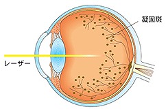 レーザー治療（レーザー光凝固術）