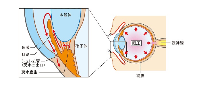 緑内障の原因